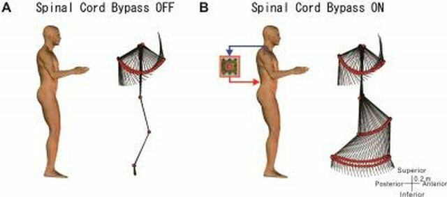 spinal-sladd-bypass